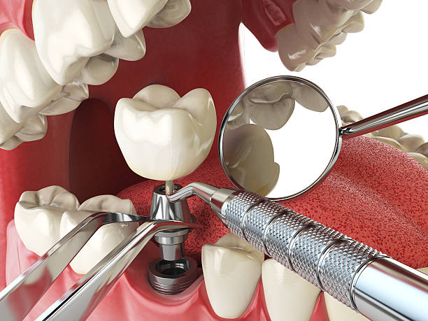 Best Emergency Treatment for Dental Infections or Abscesses in Rancho Laveras, CA